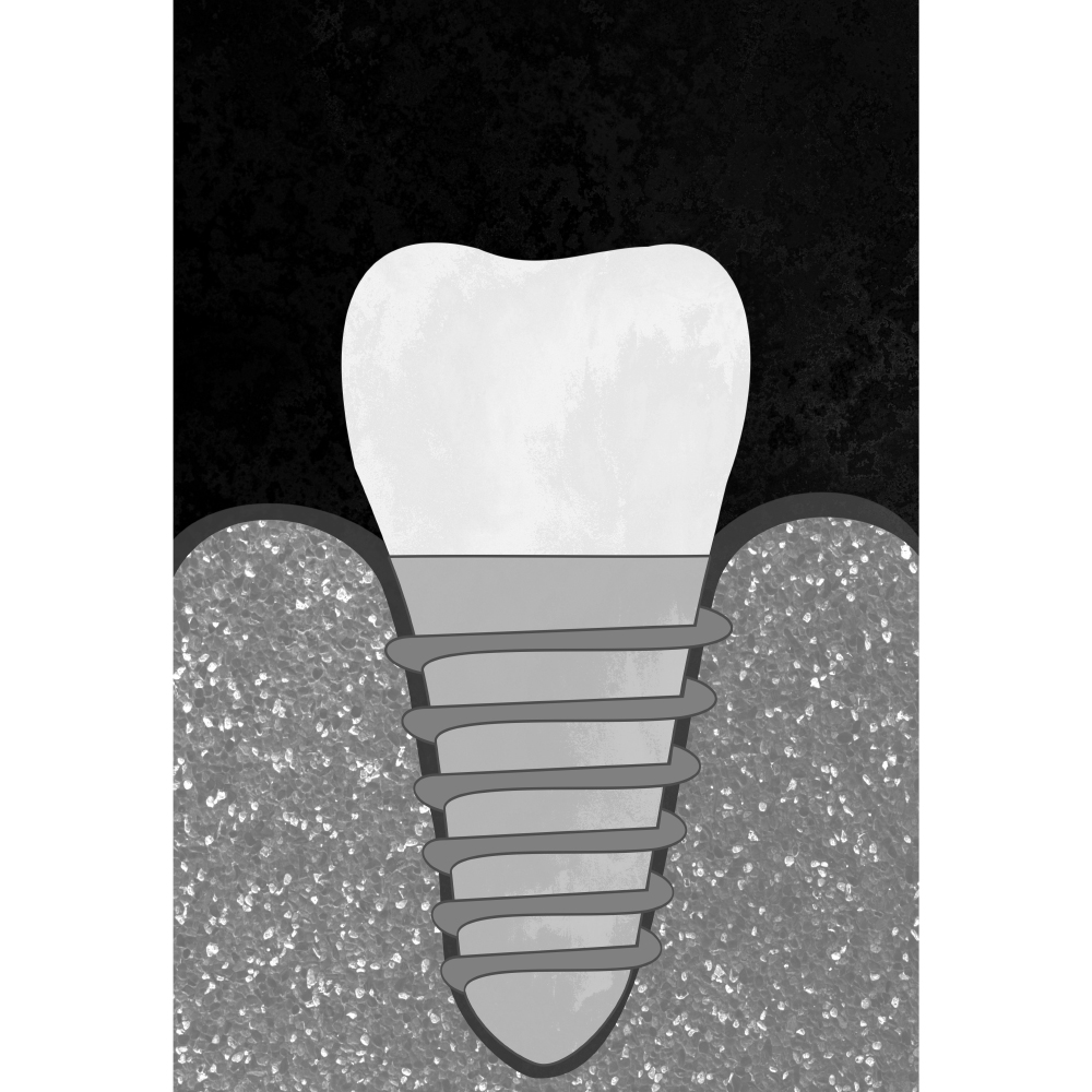 Gravura para Quadros Profisso Dentista Implante Dentrio - Afi10962